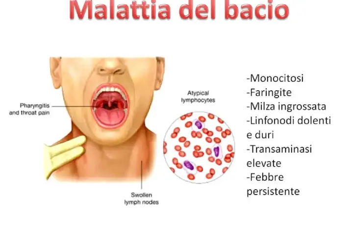 Malattia del bacio: sintomi come faringite, linfonodi dolenti, febbre persistente e monocitosi.