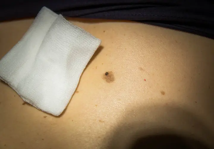 Skóra z licznymi pieprzykami, jeden większy, ciemniejszy, obok opatrunek z gazy.