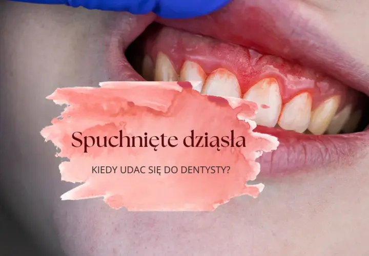 Opuchnięte dziąsło? Natychmiastowa ulga i kiedy do dentysty
