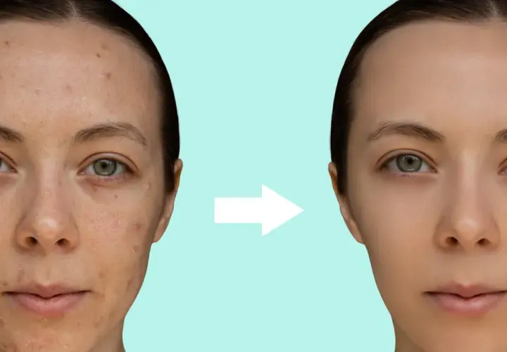 Przed i po zastosowaniu kwasu pirogronowego: skóra z niedoskonałościami staje się gładka i czysta.
