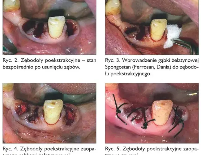Krwawienie po wyrwaniu zęba: ile trwa i kiedy szukać pomocy?