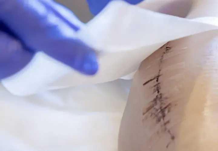 Ręka w niebieskiej rękawiczce delikatnie dotyka opatrunku na skórze, ukazując ślady po zabiegu, które mogą sugerować martwicę po lipolizie.