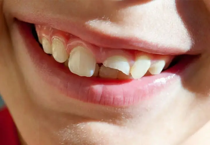 ¡Ay, se me ha caído un diente! ¿Qué hago? La sonrisa de un niño con un diente roto y un espacio vacío.