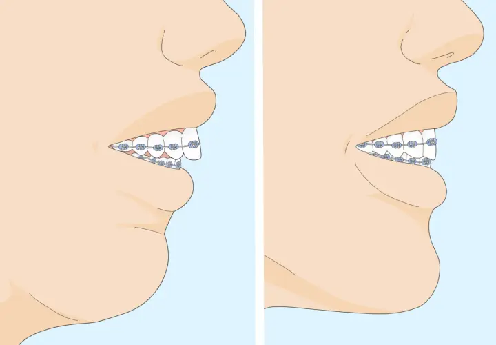 Perfil de una boca con ortodoncia. A la izquierda, se muestra una sobremordida severa. A la derecha, los dientes están alineados.