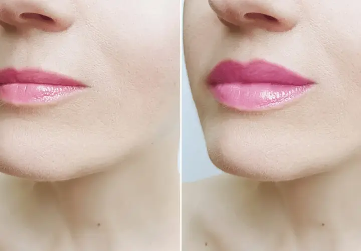 Przed i po zabiegu lip flip. Zobacz, jak zmieniły się usta i poznaj lip flip cenę.