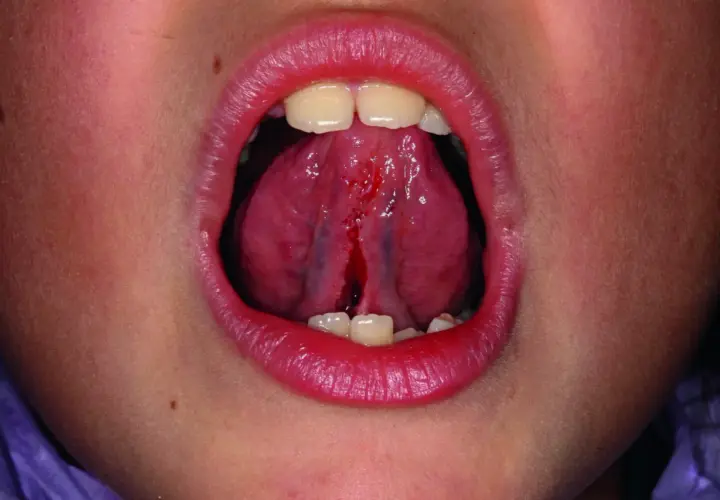Bocca aperta con lingua che mostra un frenulo linguale corto e lacerato, con sanguinamento.