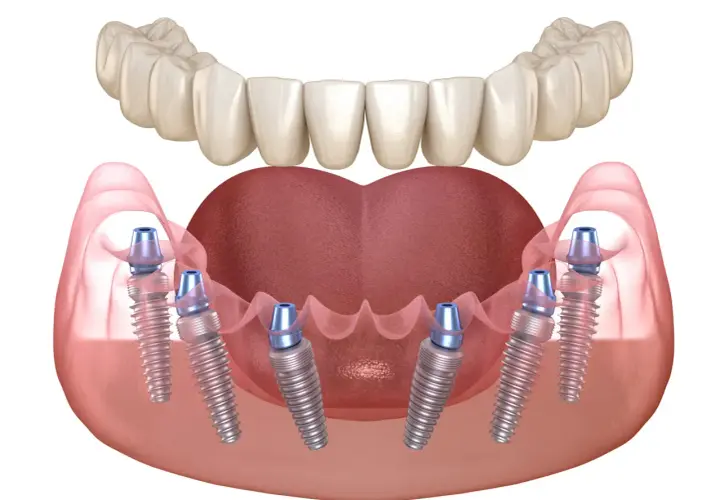 Implantes dentales en la mandíbula inferior, mostrando la integración del injerto óseo dental. Problemas de encía y hueso pueden afectar la estabilidad.