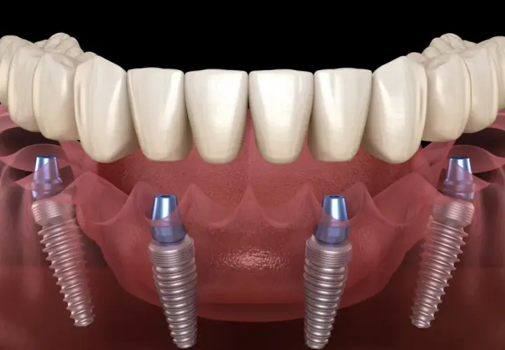 Arcata dentale fissa su quattro impianti dentali, una soluzione moderna per un sorriso completo.