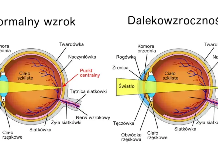Porównanie oka z normalnym wzrokiem i dalekowzrocznością. Światło skupia się za siatkówką przy dalekowzroczności.