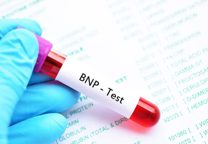 Blauer Handschuh hält Blutprobe für BNP-Test. Laborbericht im Hintergrund zeigt verschiedene Werte, darunter den BNP Wert.