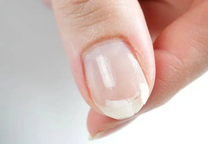 Zbliżenie na paznokieć z widocznymi przebarwieniami i łuszczeniem.