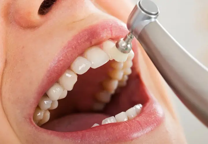 La pulizia dei denti con uno strumento rotante per un sorriso smagliante.