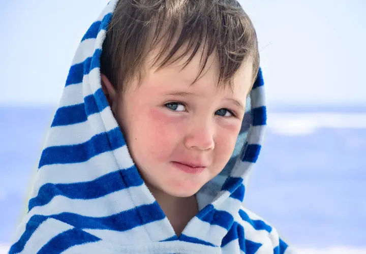 Bambino con guance arrossate, forse per la dermatite da sabbia, avvolto in un accappatoio a righe blu e bianche.