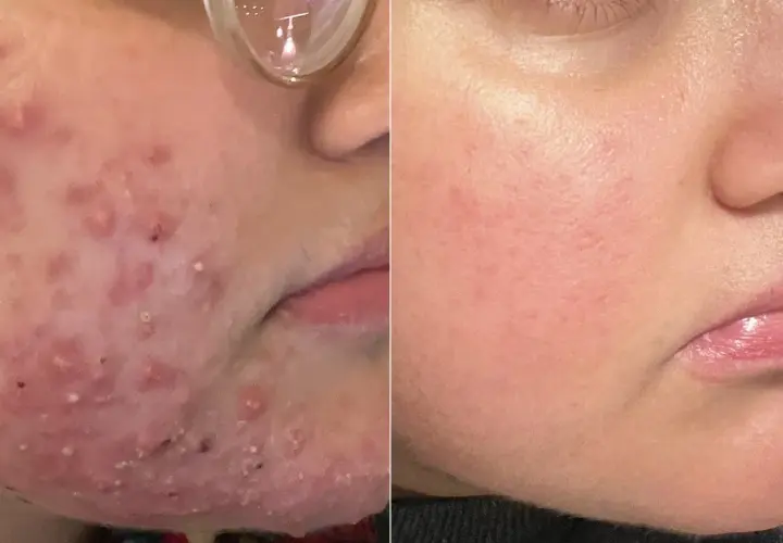 Före- och efterbilder visar hud med akne som blivit slät. En fin, rak mustasch kan nu framhävas.