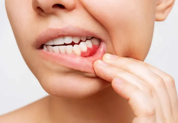 Encía inflamada y enrojecida, señal de qué es la periodontitis.