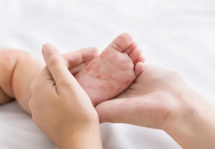 Pieds et mains rouges d'un bébé, possiblement liés au traitement du pied-main-bouche.