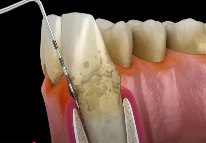 Ząb z kamieniem nazębnym i narzędzie dentystyczne. To ilustracja pokazująca, czym jest periodontologia i jak wygląda leczenie.