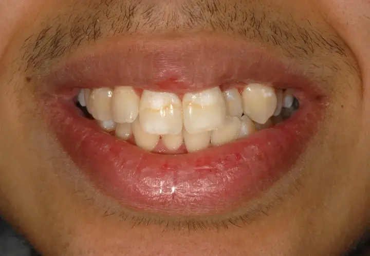 Denti con macchie bianche, possibili segni di carie iniziale.