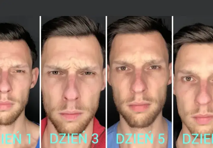 Postęp zabiegu botox dzień po dniu. Mężczyzna na zdjęciach pokazuje zmiany na swojej twarzy po zabiegu.