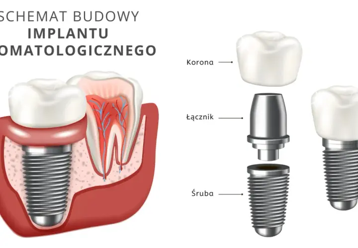 Schemat budowy implantu stomatologicznego. Dowiedz się, ile kosztuje implant zęba i jak jest zbudowany: śruba, łącznik, korona.