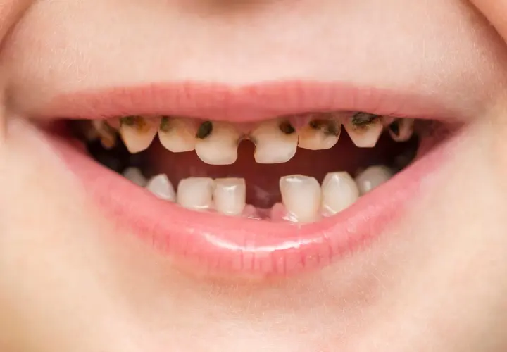 Boca de niño con dientes muy dañados por caries, algunos rotos y oscuros. Es importante recordar que las caries se contagian.