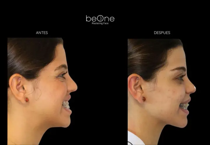 Perfil de una mujer antes y después de usar brackets. La imagen muestra la evolución de su cara y labios.