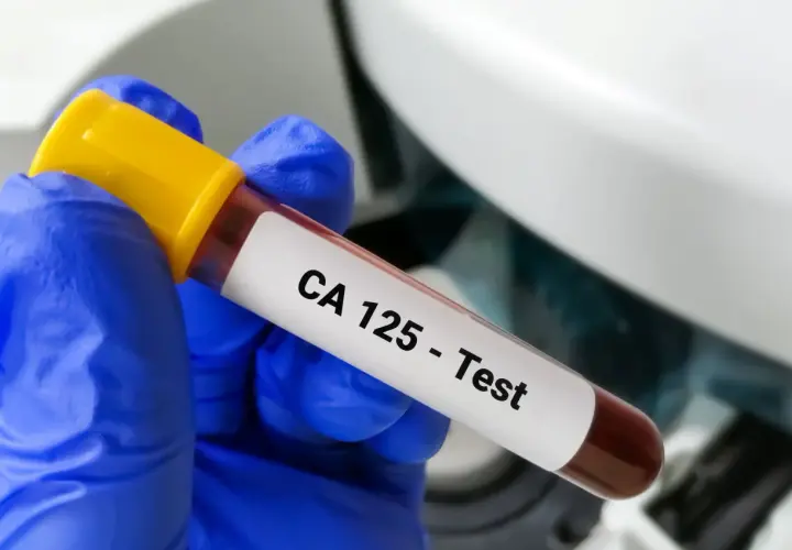 Ręka w niebieskiej rękawiczce trzyma probówkę z krwią z etykietą "CA 125 - Test". To badanie pomaga wykryć pewne schorzenia.