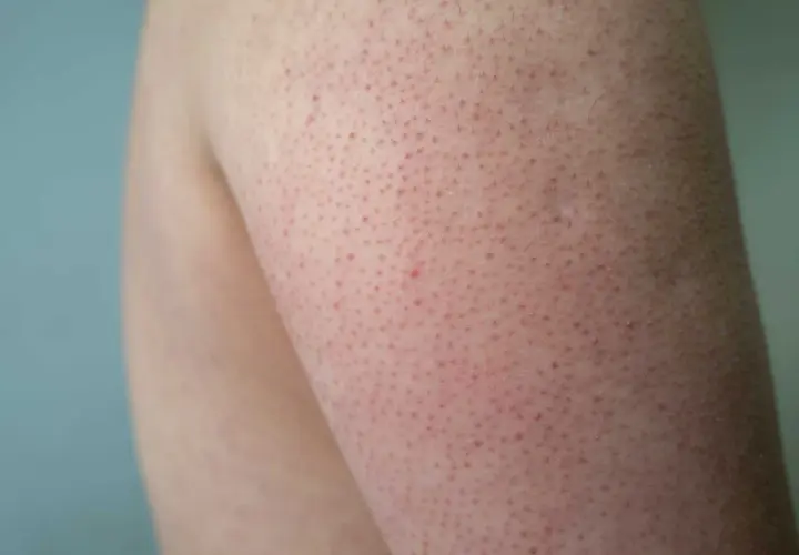 Närbild på knottriga ben med små röda prickar. Huden ser lite irriterad ut.