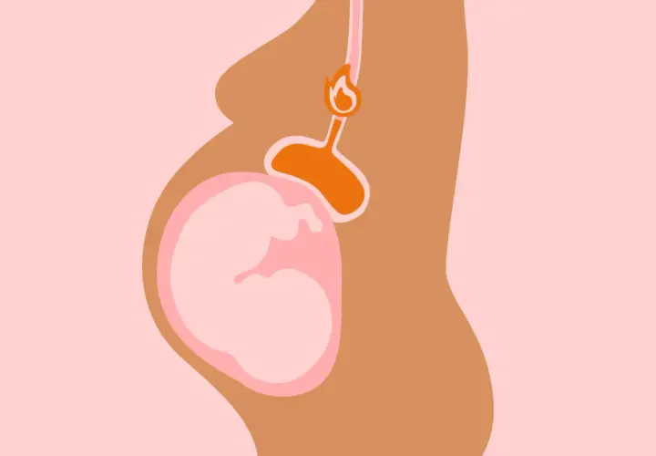 Illustration d'une femme enceinte montrant le bébé et l'estomac, avec une flamme symbolisant le **remonter acide grossesse**.