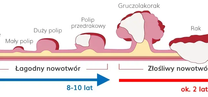 Stolec przy raku jelita grubego: kluczowe zmiany i objawy
