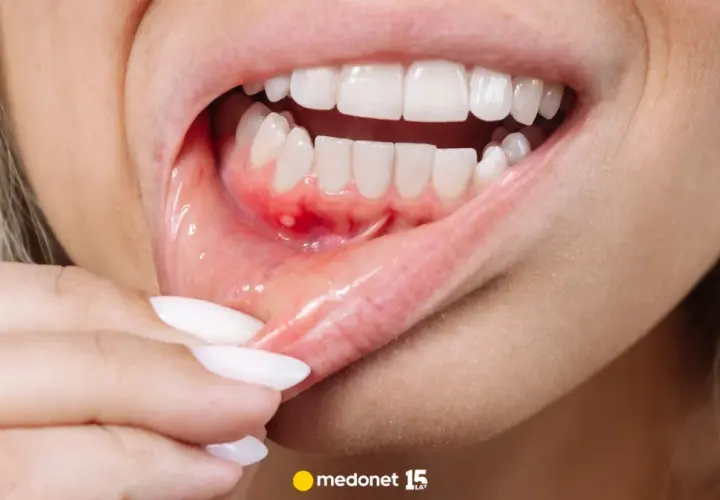 Bolące dziąsła? Szybka ulga i leczenie kiedy do dentysty?