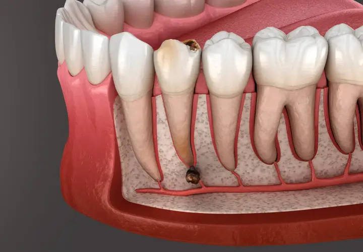 Corte transversal de una muela con caries avanzada y absceso. La infección se extiende a la raíz, mostrando las posibles consecuencias de no extraer una muela con infección.