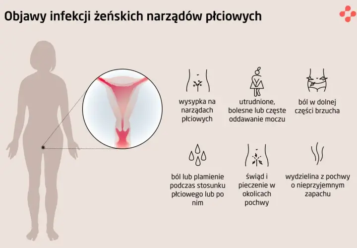 Objawy infekcji intymnej: wysypka, ból brzucha, pieczenie, wydzielina z pochwy. Ilustracja przedstawia objawy infekcji żeńskich narządów płciowych.