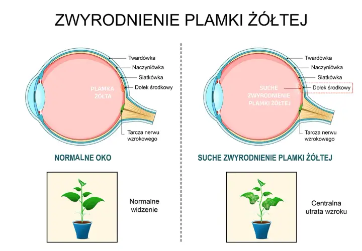 Porównanie zdrowego oka z suchym zwyrodnieniem plamki żółtej, pokazujące utratę ostrości widzenia.