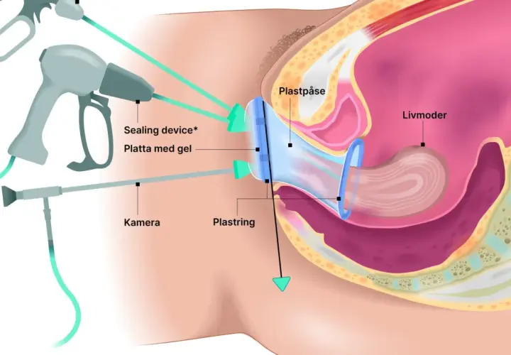 Illustration visar en medicinsk procedur för vaginal åtstramning med en kamera och en plastpåse som används för att dra åt.