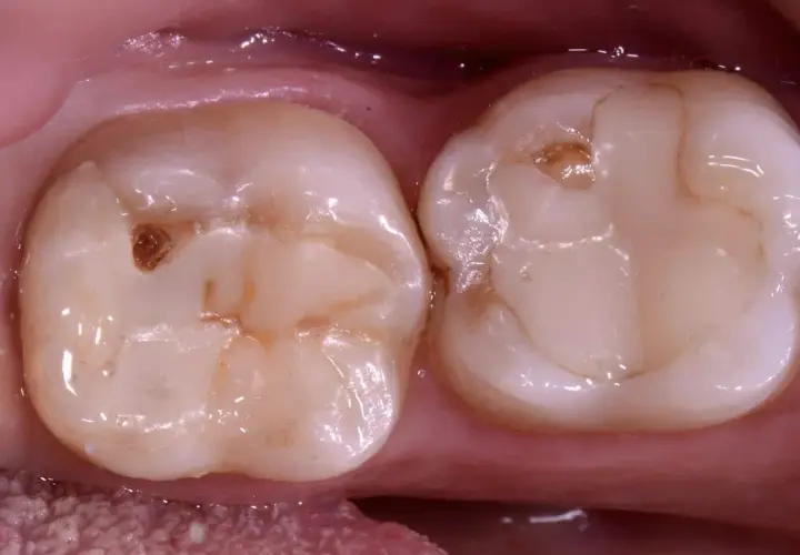 Due denti con un piccolo buco nel dente senza carie, forse un segno di usura o un'antica otturazione.