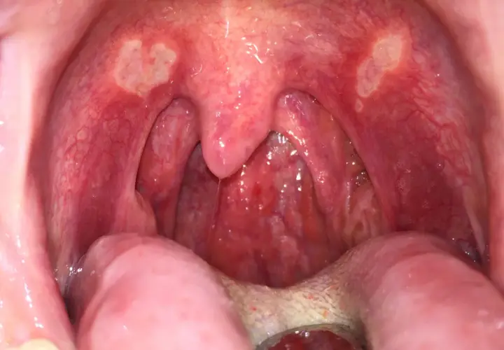 Gola arrossata con afte sul palato e sulle tonsille. Si notano lesioni biancastre e infiammazione.