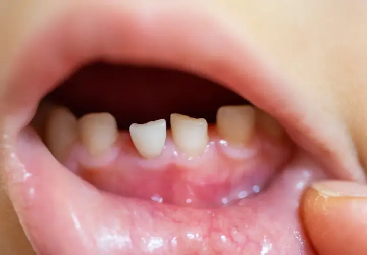 Bocca di bambino con denti da latte spuntati, gengive arrossate. Potrebbe essere la **febbre da dentizione**.