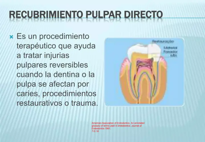 Diagrama de un diente mostrando el recubrimiento pulpar directo, un procedimiento para tratar injurias reversibles en la pulpa dental.