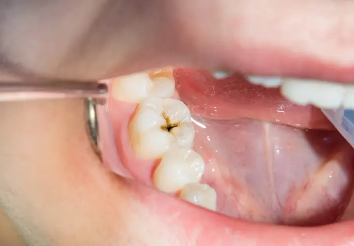 Diente con una cavidad oscura, mostrando por qué salen caries.