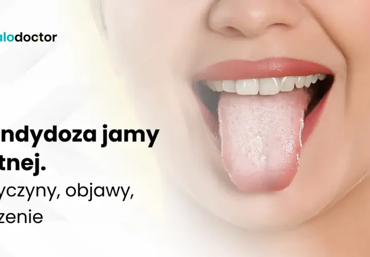 Kandydoza jamy ustnej: objawy, przyczyny i kiedy iść do lekarza