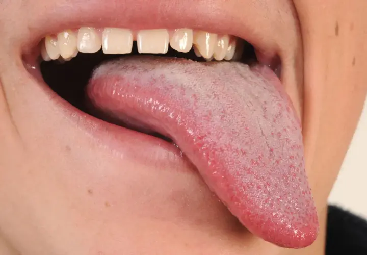 Boca abierta mostrando lengua rosada con pequeñas protuberancias rojas, quizás por eso salen granos en la lengua.