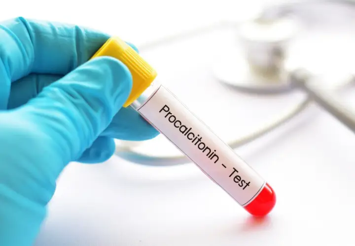 Ręka w niebieskiej rękawiczce trzyma probówkę z napisem "Procalcitonin - Test".
