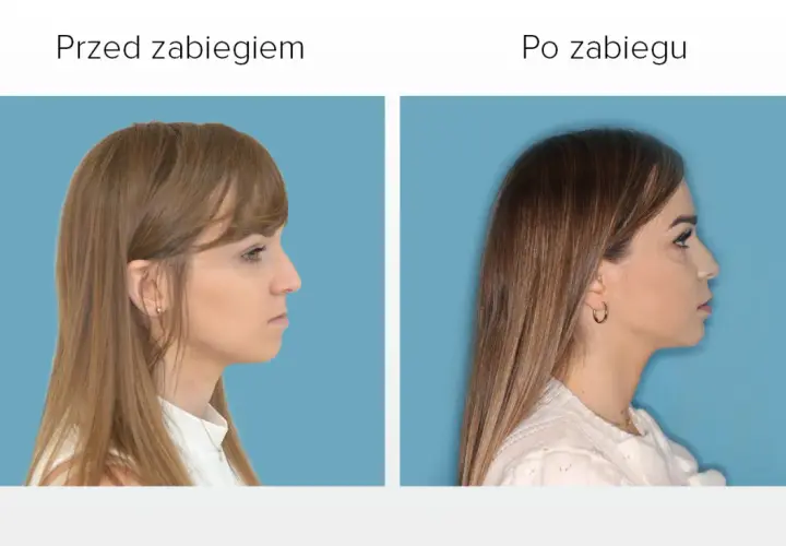 Przed i po zabiegu korekty profilu. Widoczna poprawa linii żuchwy, która wcześniej była lekko krzywa.