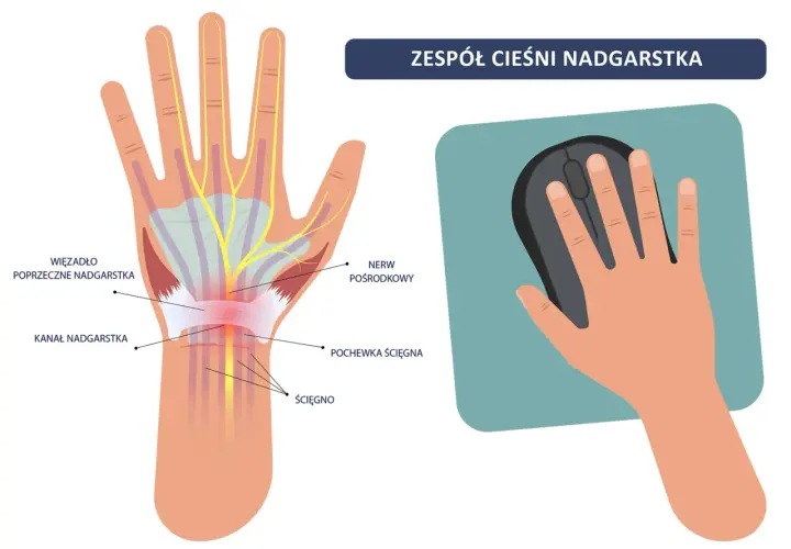 Anatomia cieśni nadgarstka i dłoń trzymająca myszkę. Ilustracja pokazuje ucisk na nerw pośrodkowy, który może prowadzić do bólu i drętwienia, a także do konieczności ubiegania się o odszkodowanie po operacji cieśni nadgarstka.