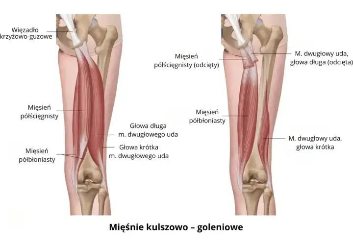 Anatomia mięśni kulszowo-goleniowych. Ilustracja pokazuje mięsień dwugłowy uda, który może powodować ból w podudziu.