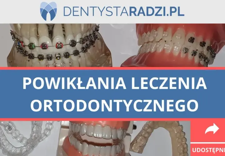 Modele szczęk z aparatami ortodontycznymi i nakładkami. Temat: powikłania leczenia ortodontycznego, w tym ból zębów po zdjęciu aparatu.