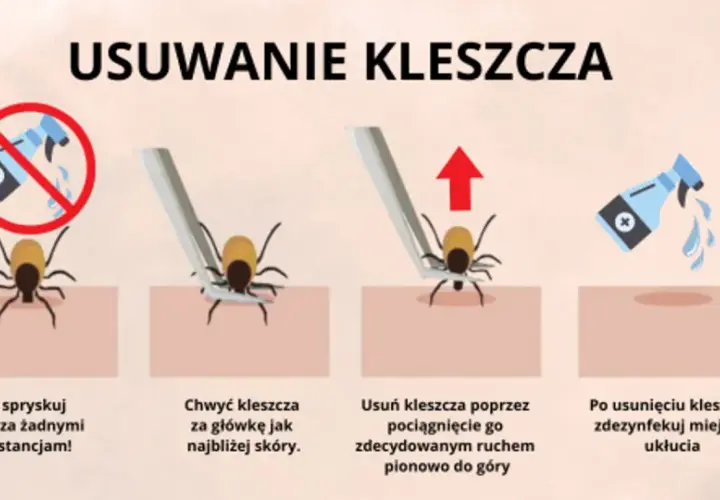 Jak bezpiecznie usunąć kleszcza? Instrukcja krok po kroku