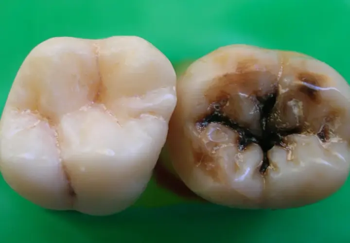 Un diente sano junto a otro con caries avanzadas, oscuras y profundas. Las caries duelen y arruinan la sonrisa.