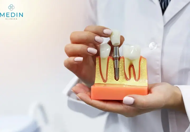 Model szczęki z implantem i koroną. Pokazuje, jak wygląda sinus lift otwarty, przygotowujący do wszczepienia implantu.
